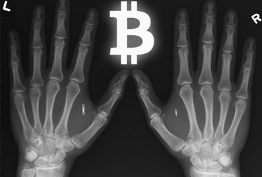 Bio-Implantable Bitcoin Wallets Becoming a Popular Storage Solution